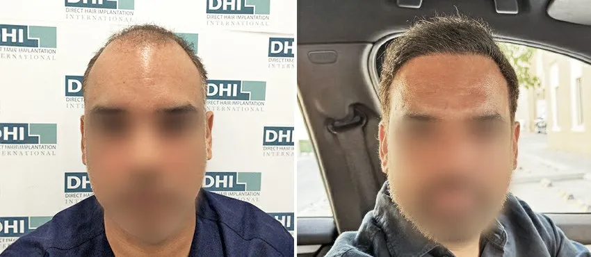DHI before & after hair transplant results