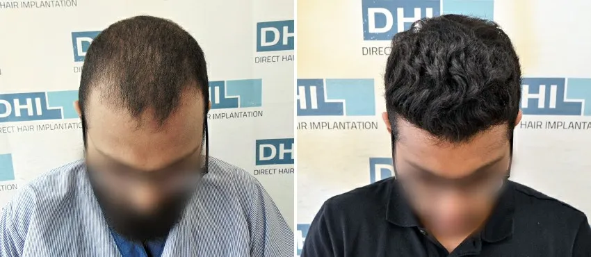 DHI before & after hair transplant results