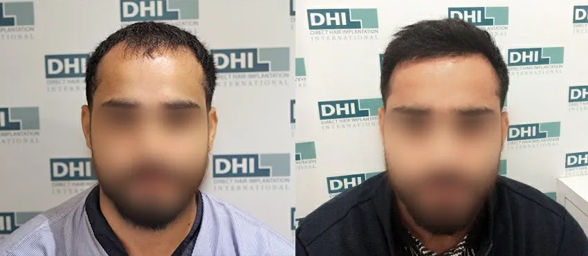 DHI before & after hair transplant results