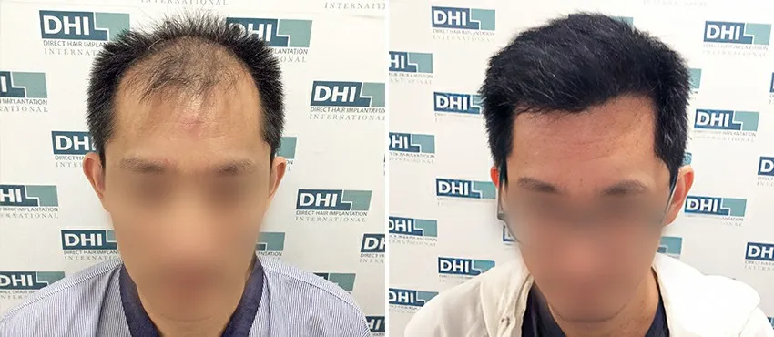 DHI before & after hair transplant results