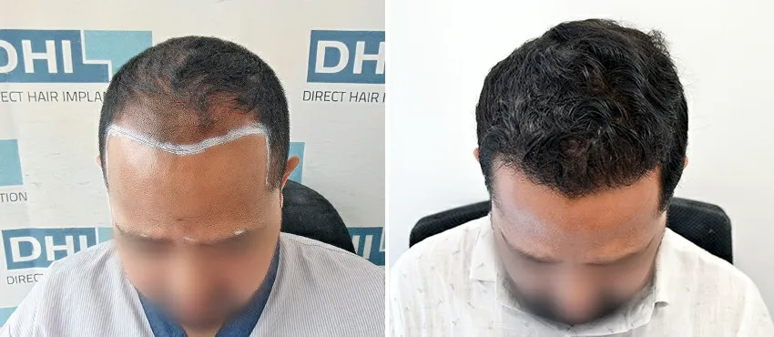 DHI before & after hair transplant results