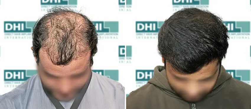DHI before & after hair transplant results