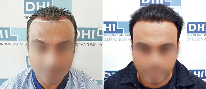 DHI before & after hair transplant results