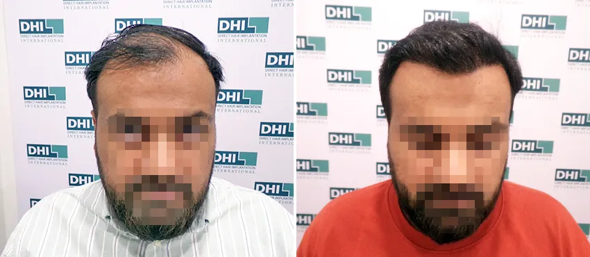 DHI before & after hair transplant results