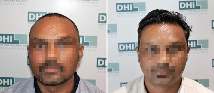 DHI before & after hair transplant results
