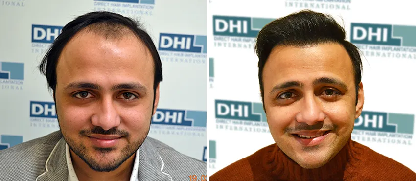 DHI before & after hair transplant results