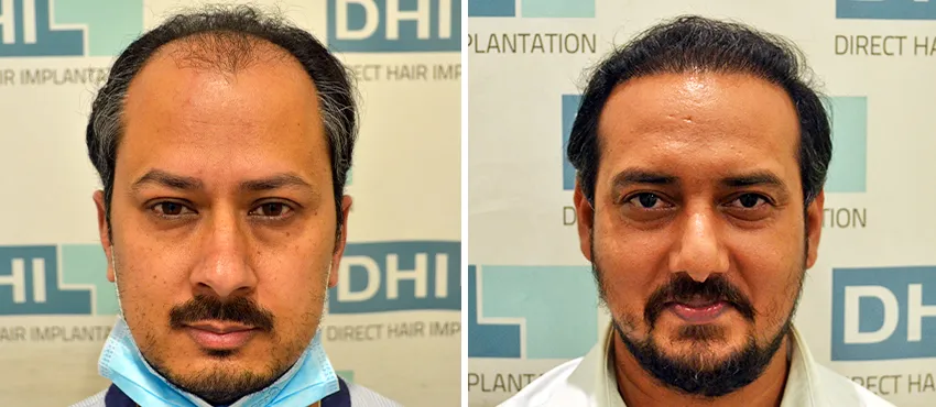dhi gives natural hairline