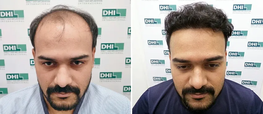 dhi gives natural hairline