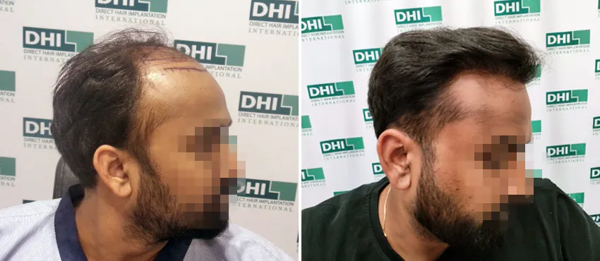 DHI before & after hair transplant results