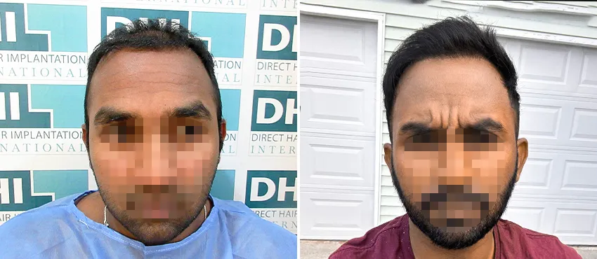 DHI before & after hair transplant results