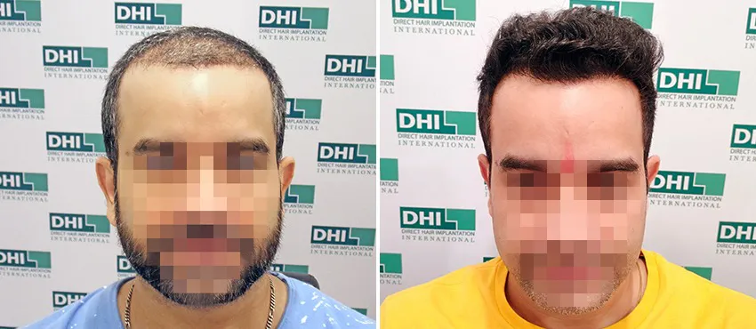 DHI before & after hair transplant results