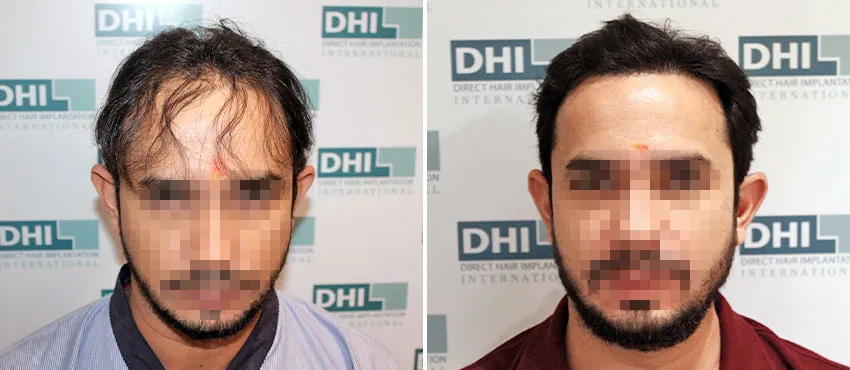 DHI before & after hair transplant results