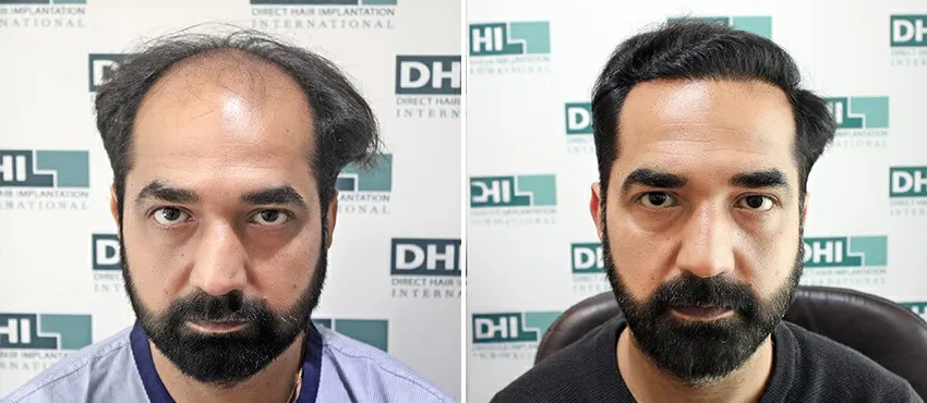 dhi gives natural hairline