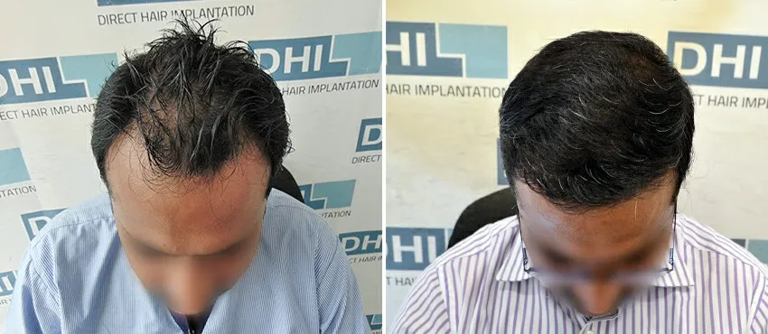 DHI before & after hair transplant results