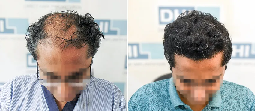 DHI before & after hair transplant results