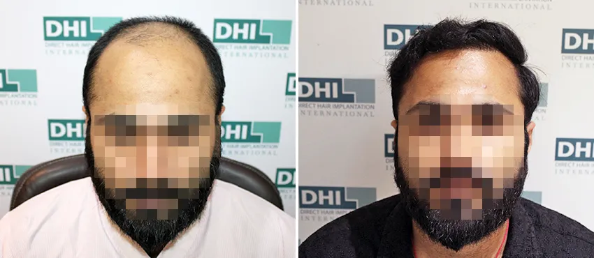 DHI before & after hair transplant results