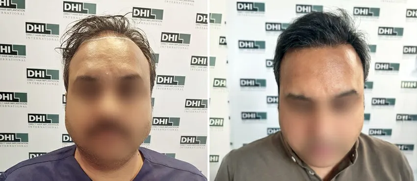 DHI before & after hair transplant results