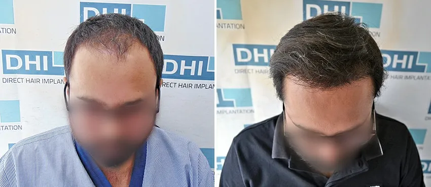 DHI before & after hair transplant results