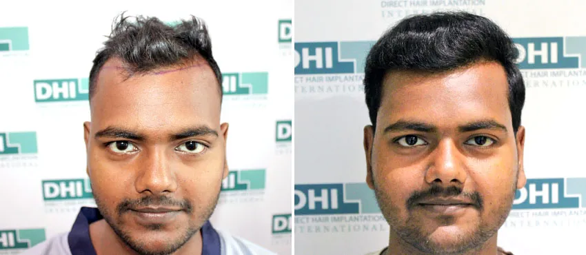 dhi gives natural hairline