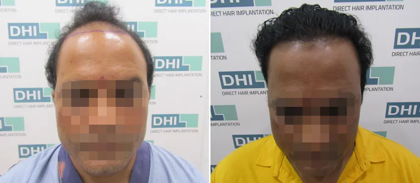DHI before & after hair transplant results