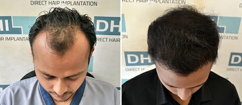 dhi gives natural hairline