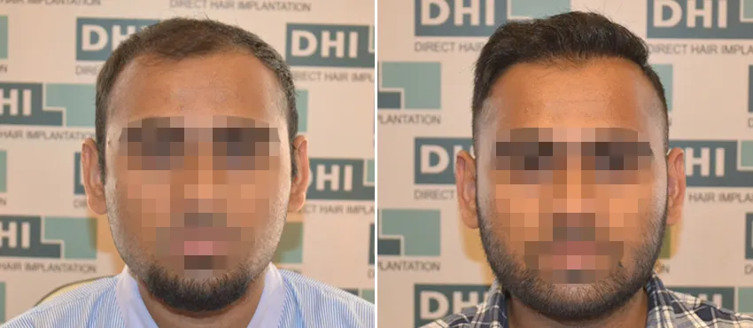 DHI before & after hair transplant results