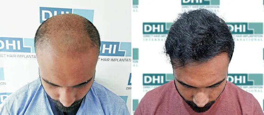 dhi gives natural hairline