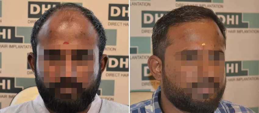 DHI before & after hair transplant results