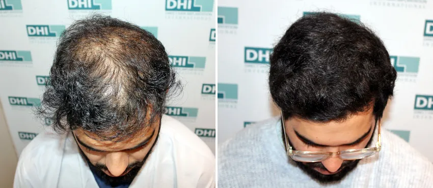dhi gives natural hairline