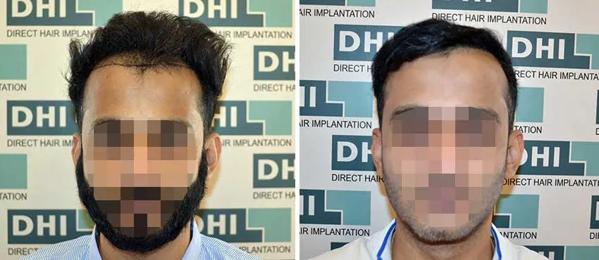 Sreejesh Ravindran before and after