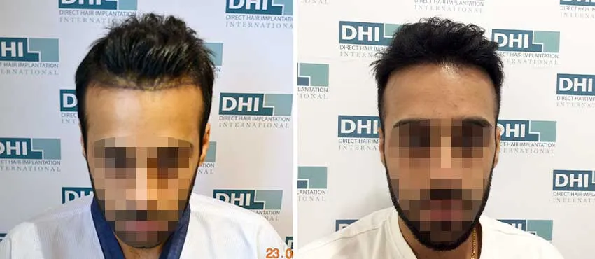 Pankaj Mirchandani before and after