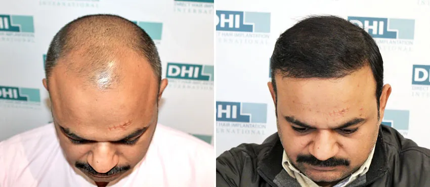 dhi gives natural hairline