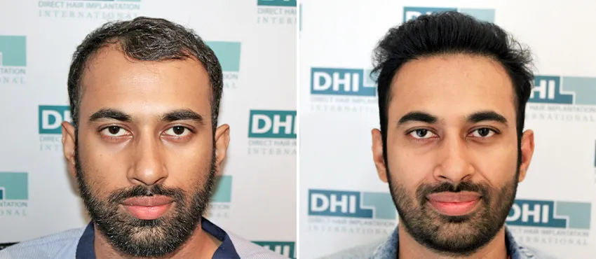 dhi gives natural hairline