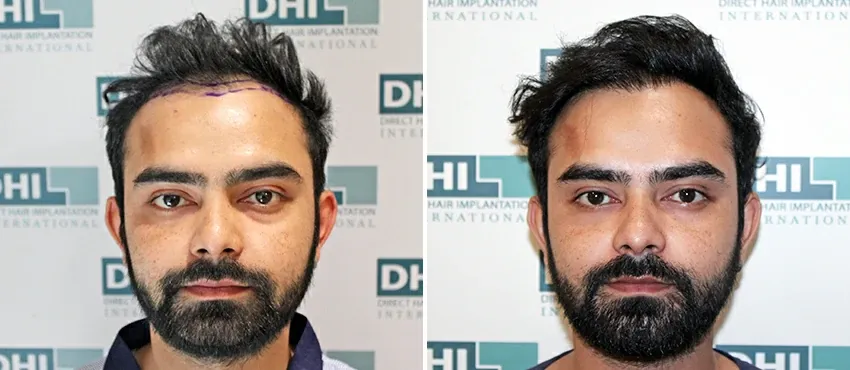 dhi gives natural hairline