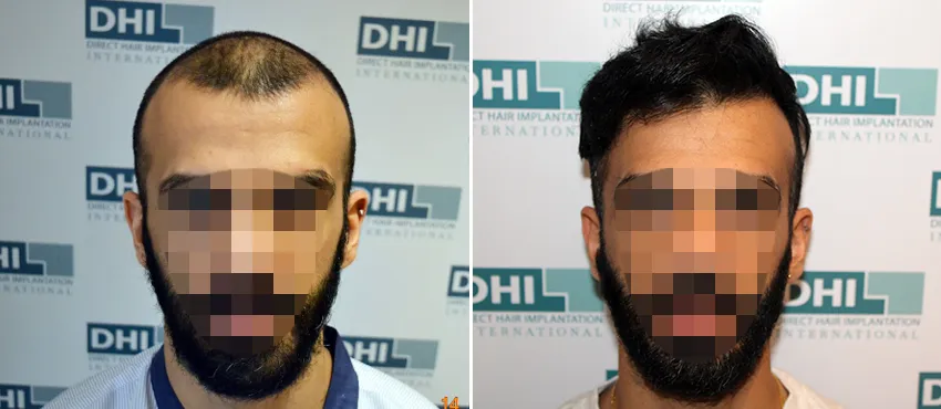 DHI before & after hair transplant results