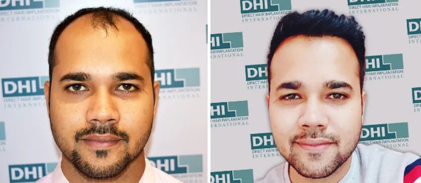 dhi gives natural hairline