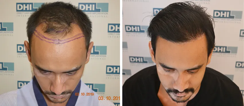 dhi gives natural hairline