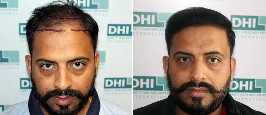 dhi gives natural hairline