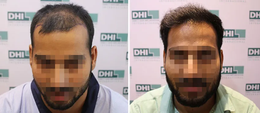 DHI before & after hair transplant results