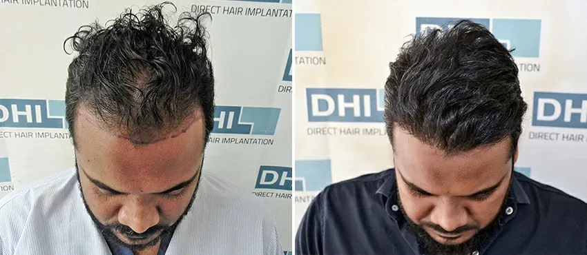 dhi gives natural hairline