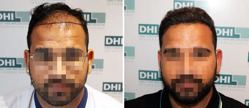 DHI before & after hair transplant results