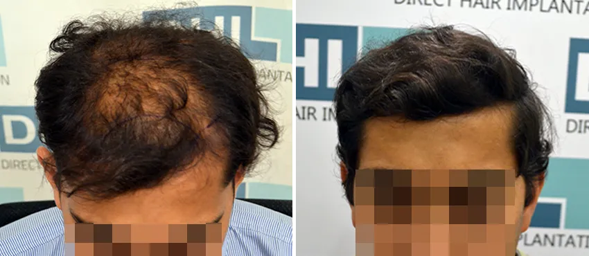 DHI before & after hair transplant results