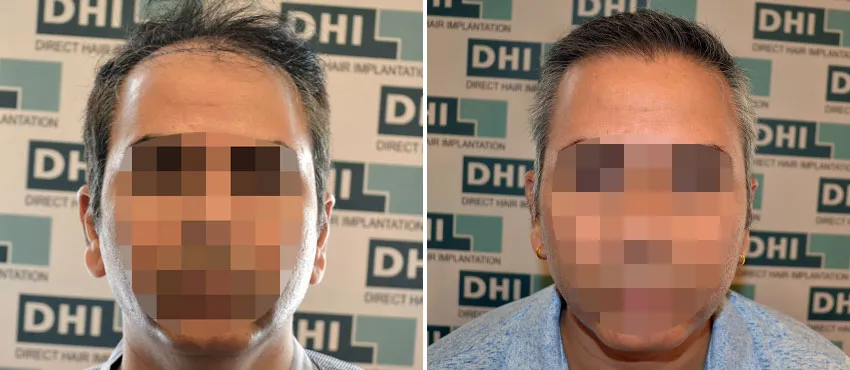 DHI before & after hair transplant results