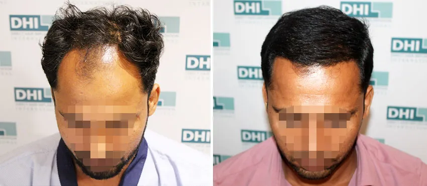 DHI before & after hair transplant results