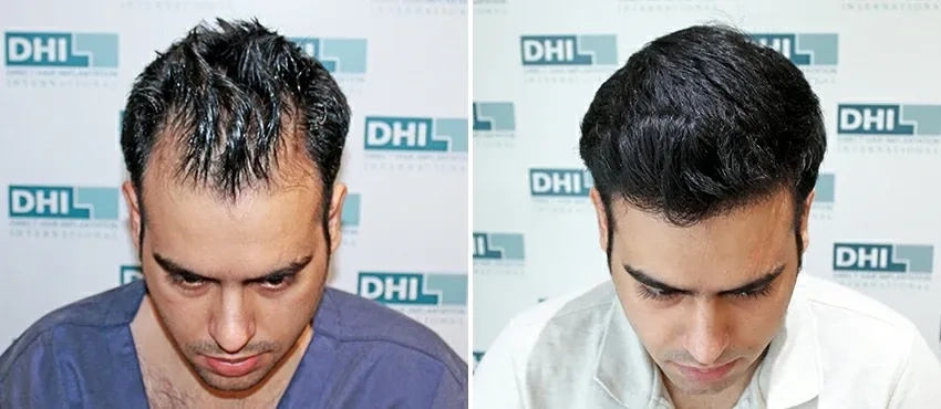 dhi gives natural hairline