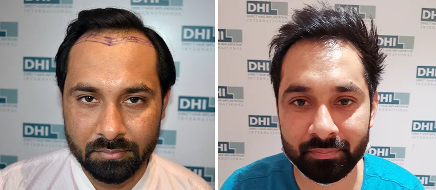 dhi gives natural hairline