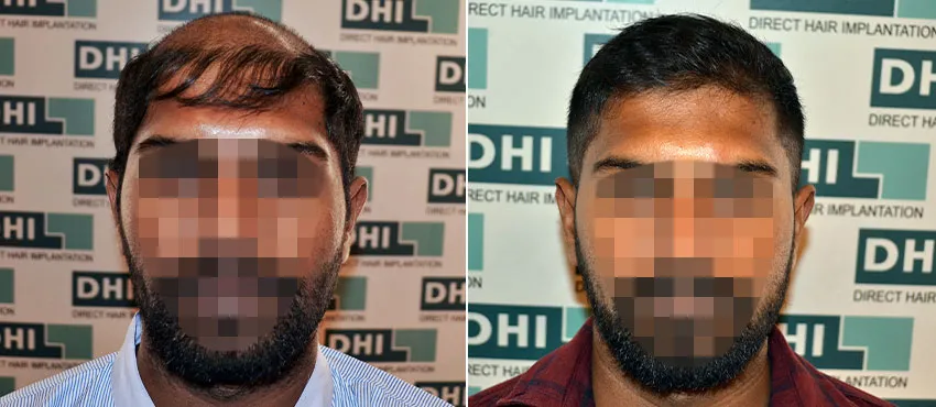 DHI before & after hair transplant results