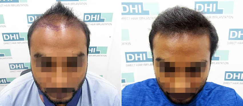 DHI before & after hair transplant results