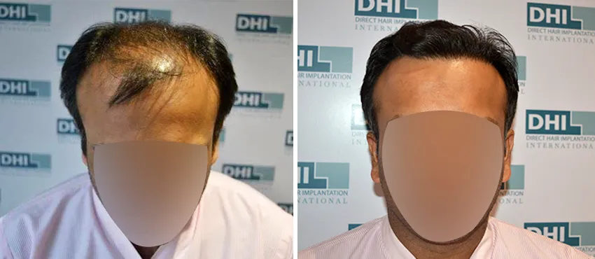 DHI before & after hair transplant results
