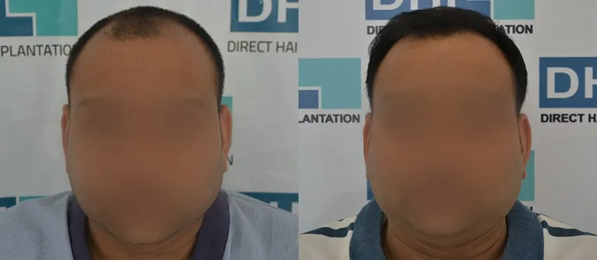 DHI before & after hair transplant results